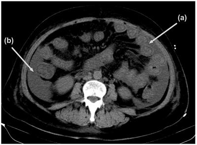 Successful management of belimumab after obinutuzumab in a patient with systemic lupus erythematosus: a case report with an 18-month follow-up